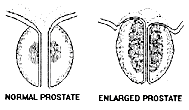 enlarged prostate