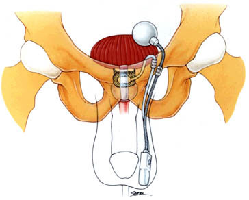 Artificial Urinary Sphincter, AUS-800, male